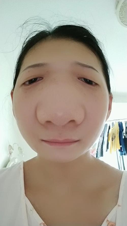 今晚开奖结果号码和挖鼻孔满脸肿胀变形与挖鼻孔满脸肿胀变形怎么办